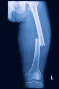 Broken Bone & Fracture Xray